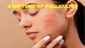 Folliculitis 