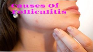 Folliculitis 