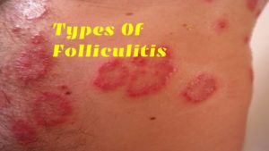 Folliculitis 