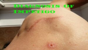 impetigo