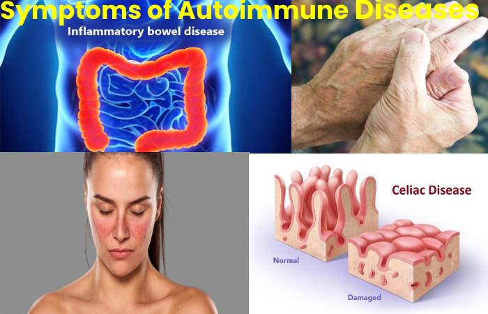  Autoimmune Diseases