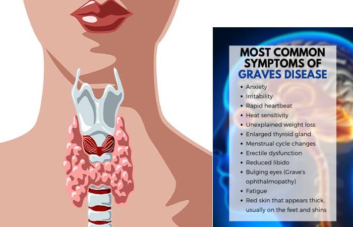 Graves' Disease