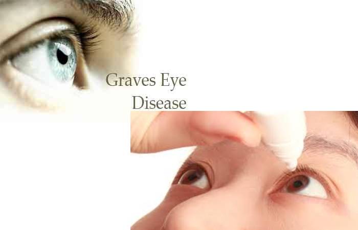 Graves' Disease