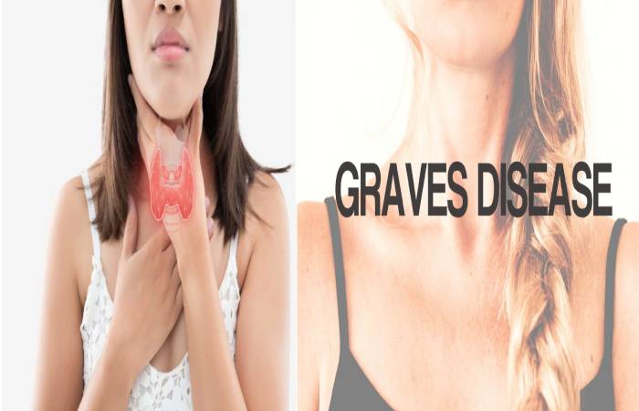 Graves' Disease