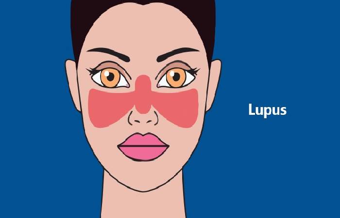 Lupus