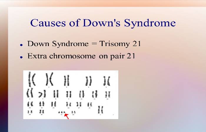 Down Syndrome 