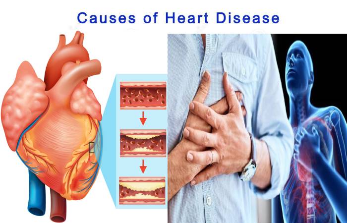 Heart Disease Definition Symptoms Causes Risk Factors And More