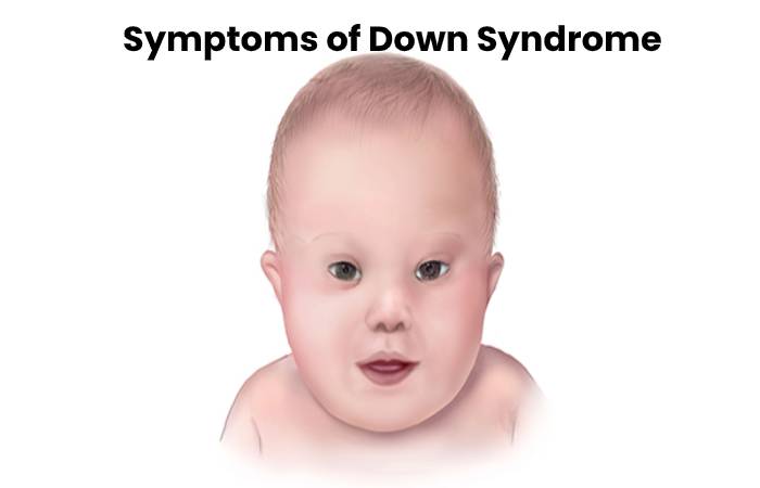 Symptoms of Down Syndrome