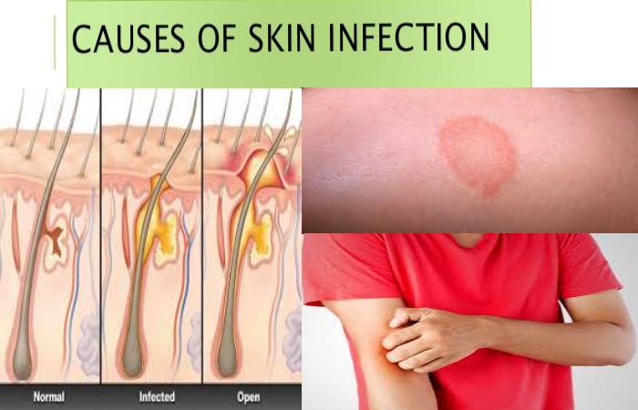 skin infections