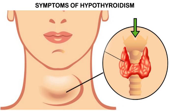 hypothyroidism