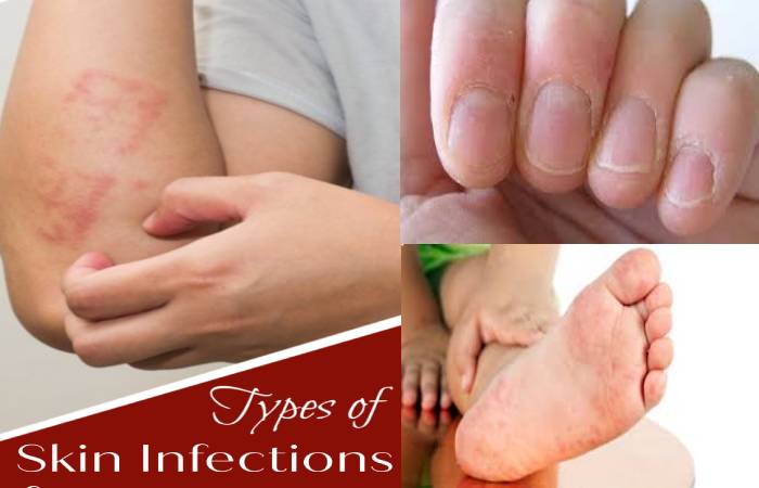 What Are Skin Infections Causes Symptoms Types And More 