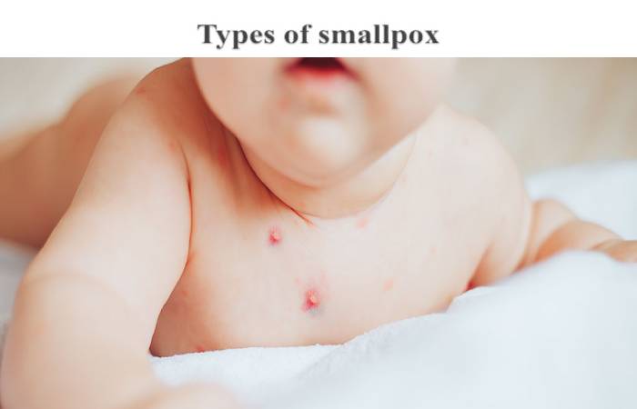 smallpox