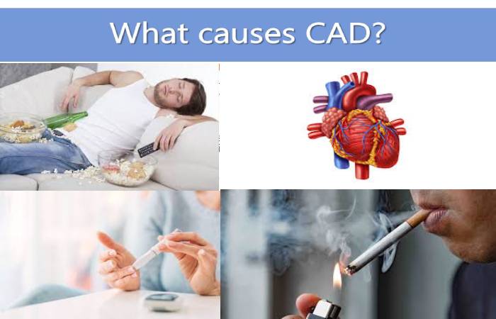 coronary artery disease