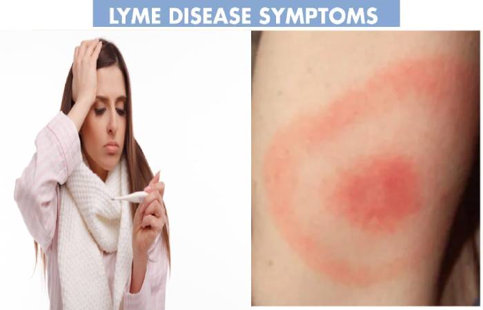 lyme disease