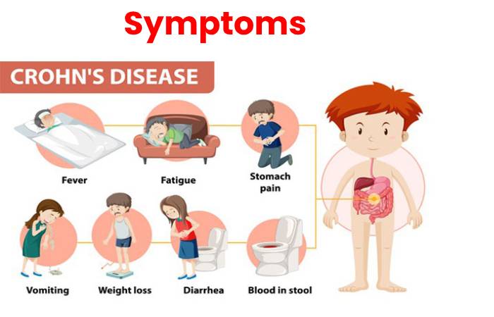 crohn's disease