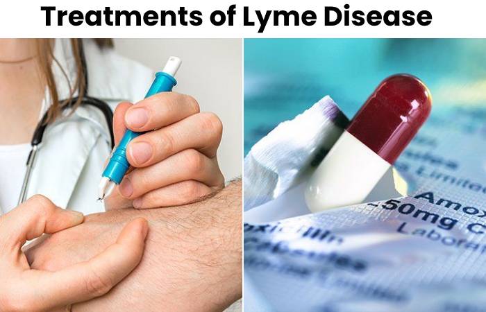 lyme disease