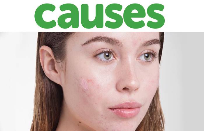 acne scars