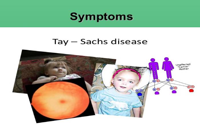 tay-sachs disease