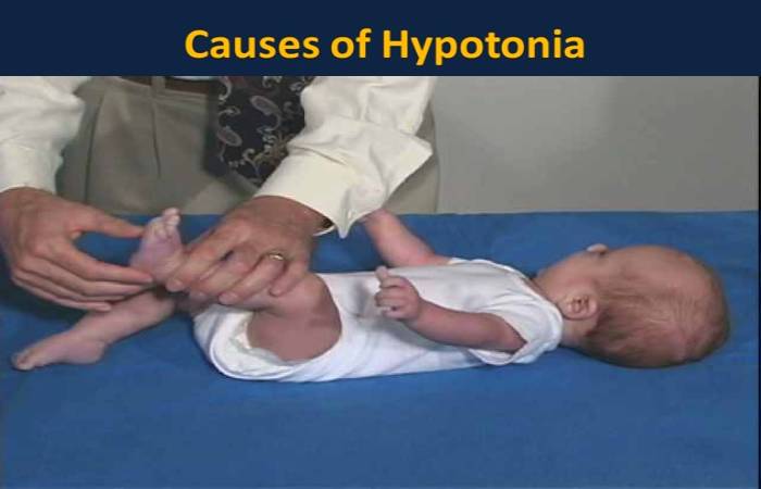 hypotonia