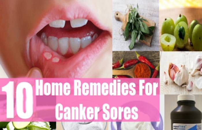 canker sores