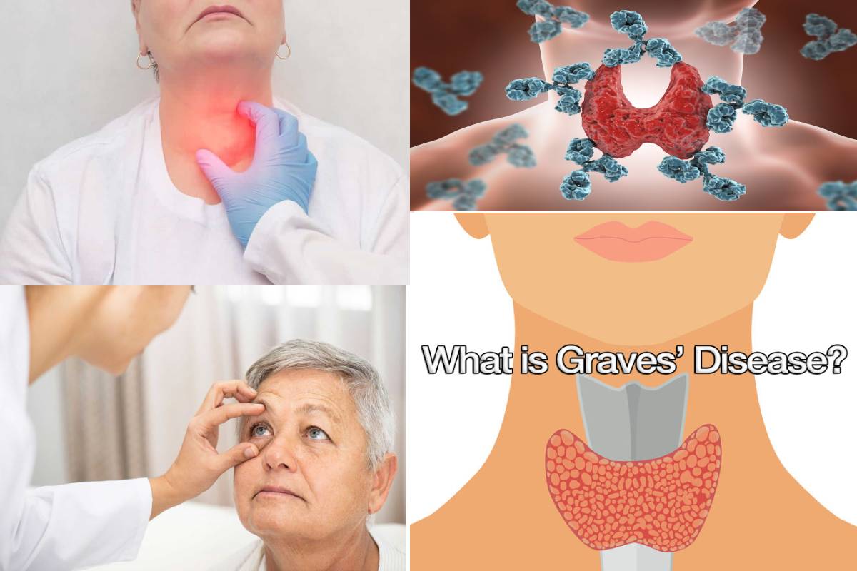 What Is Graves Disease Definition Symptoms Causes And More