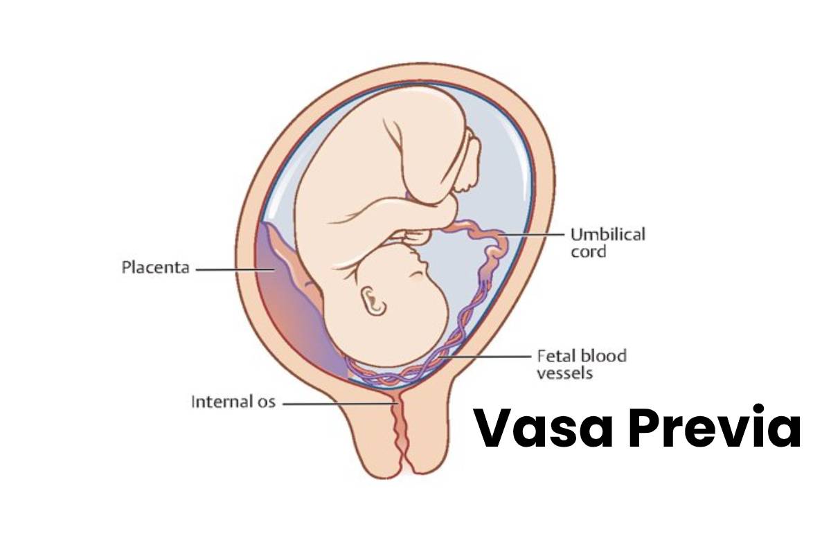 What Is Vasa Previa Symptoms Causes Diagnosis And More