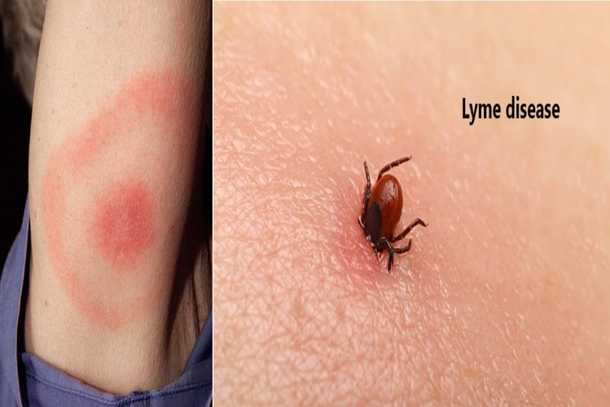 dredge report article on lymes disease