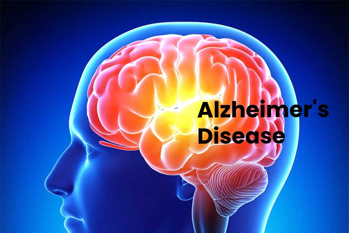 Alzheimer's Disease Definition, Symptoms, Causes, and More